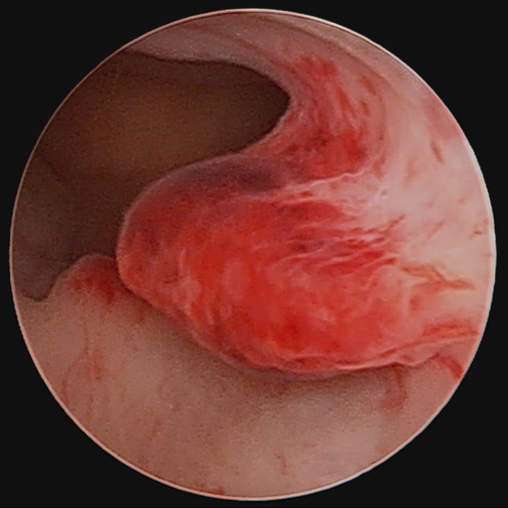 Endometrium-Polyp Hysteroskopie