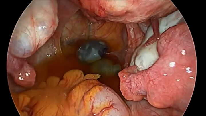Abdominalgravidität Laparoskopie