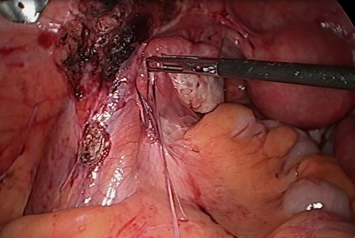 Fimbrioplastik 3