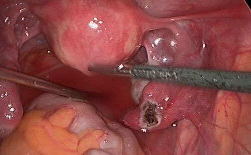 Fimbrioplastik 9