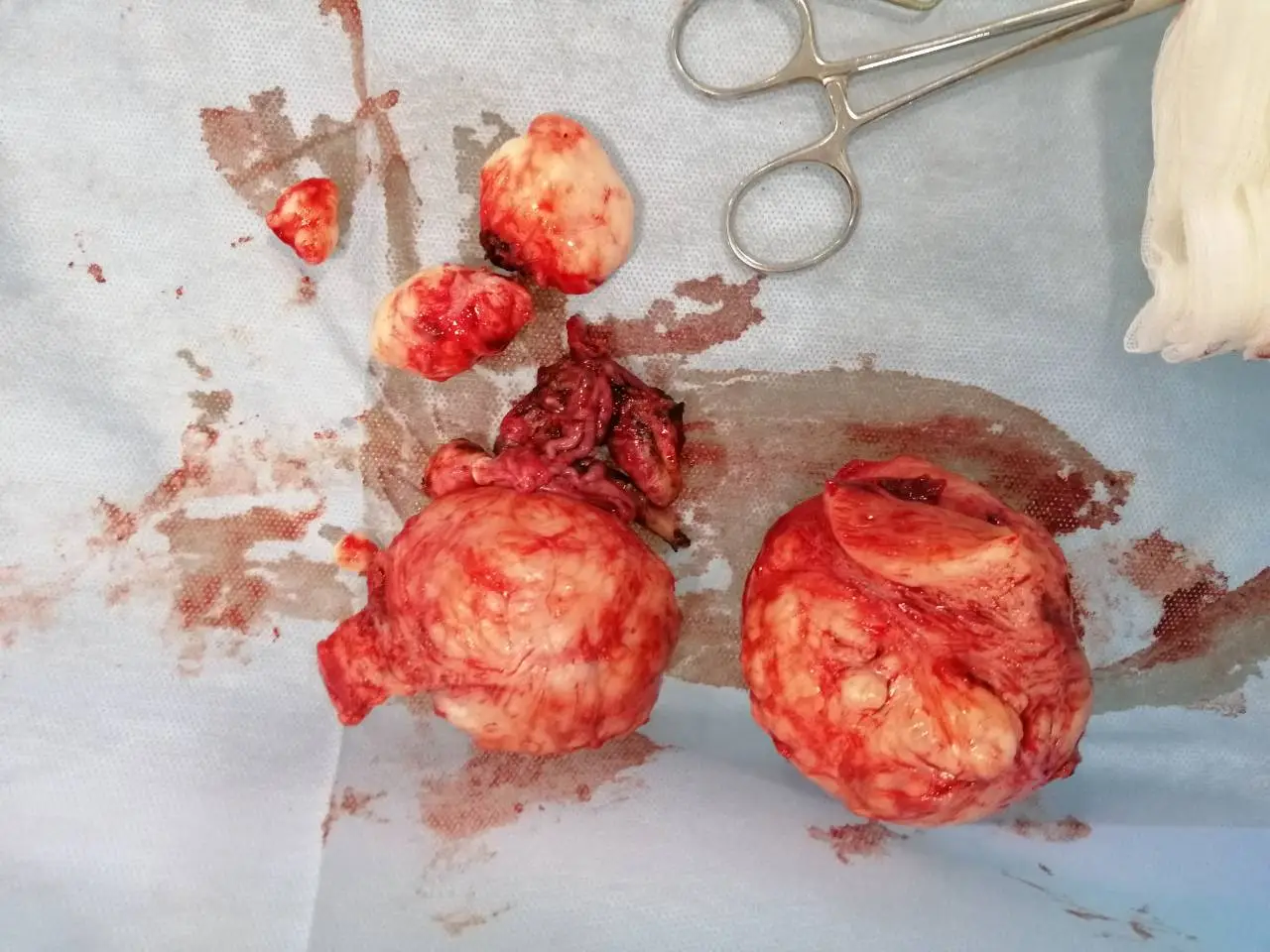 Laparotomie Schritt 24