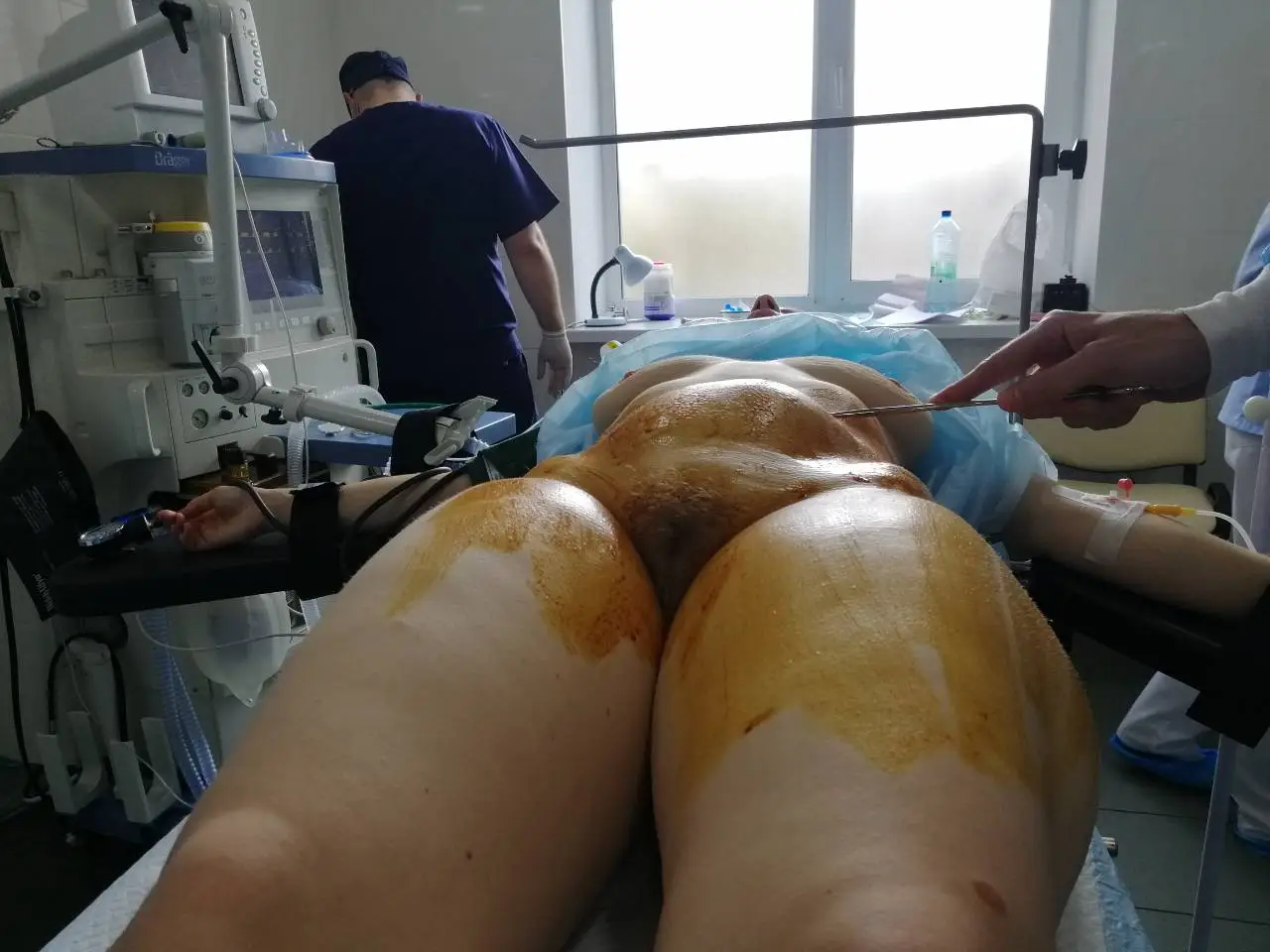 Laparotomie Schritt 3