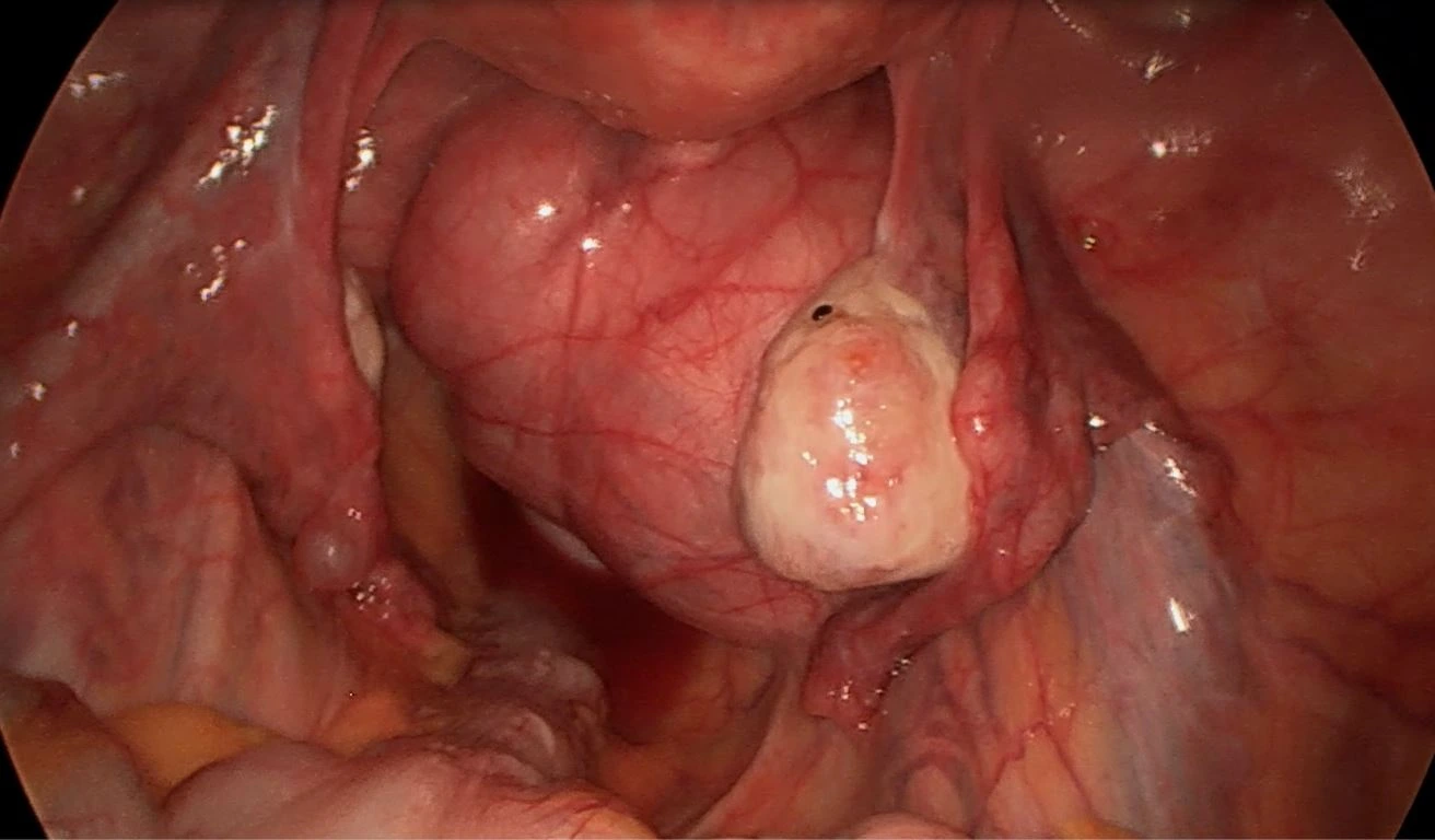 Ureterolyse 1