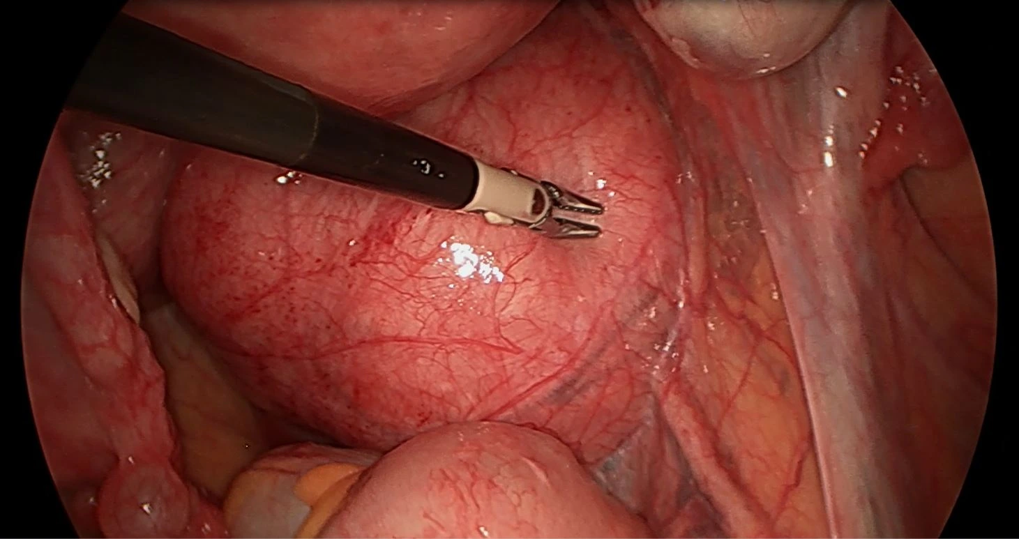 Ureterolyse 2