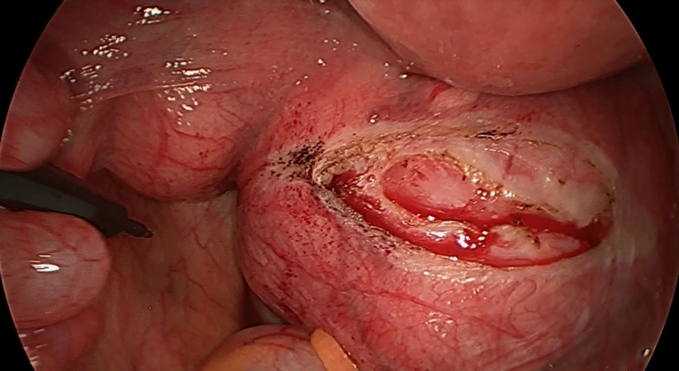 Ureterolyse 3