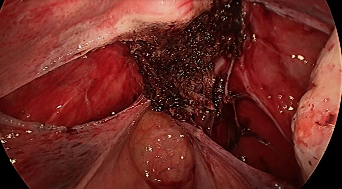 Ureterolyse 4