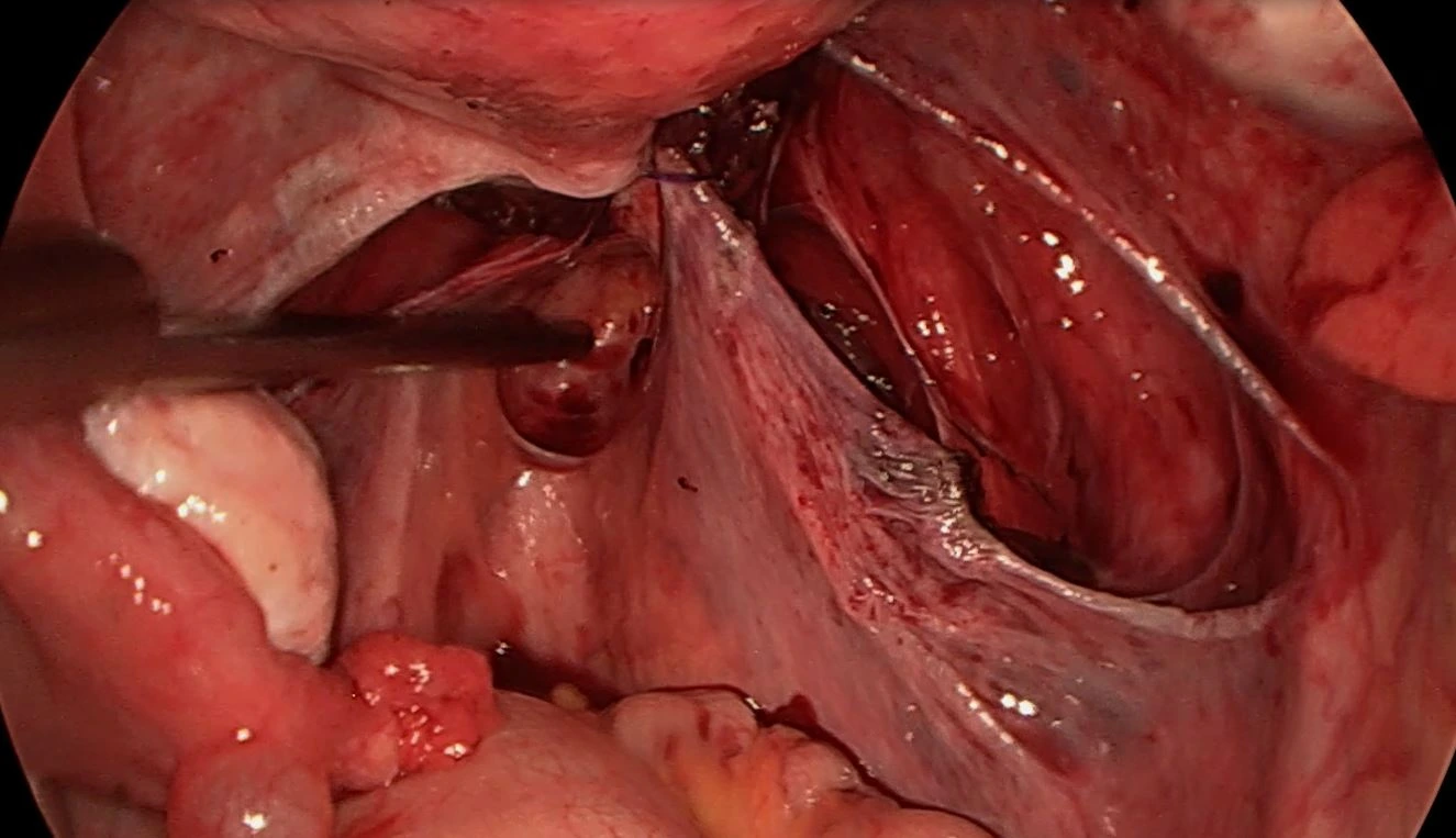 Ureterolyse 5