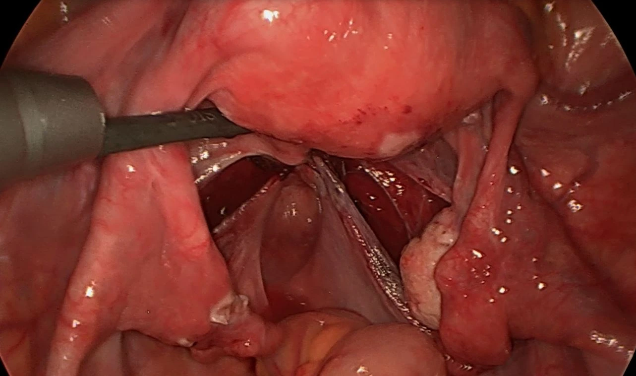Ureterolyse 6