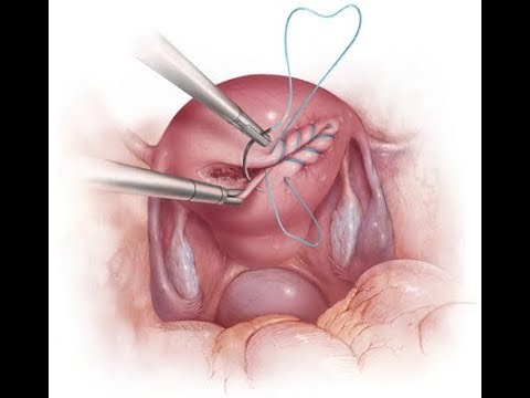 Temporäres Klippen der Uterinarterien