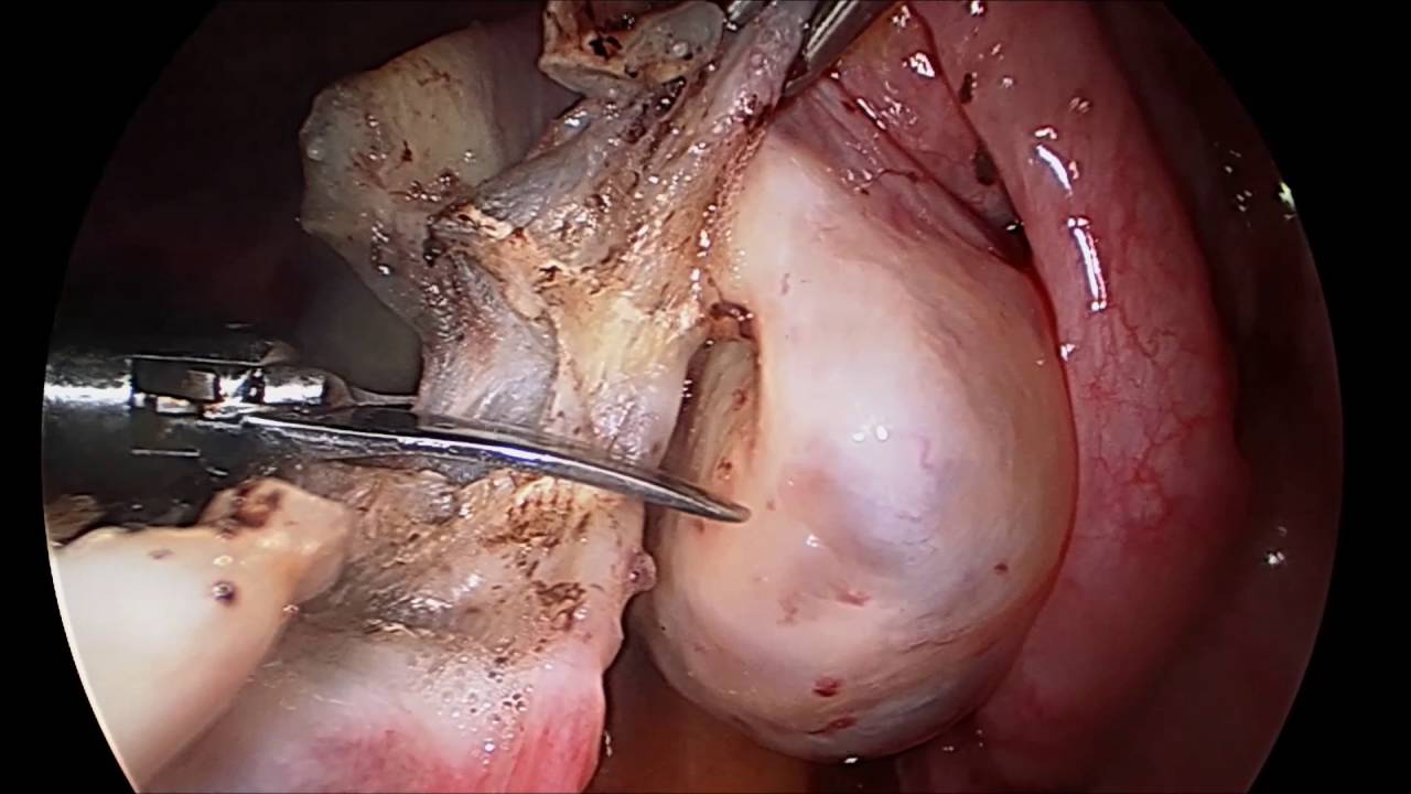 LASH Operation