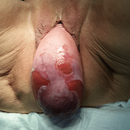 Anatomie Beckenbodenprolaps