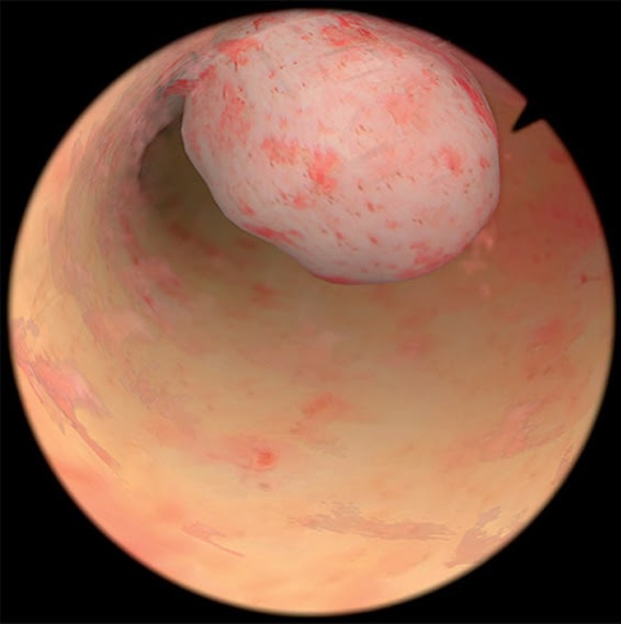 Endometriale Pathologie